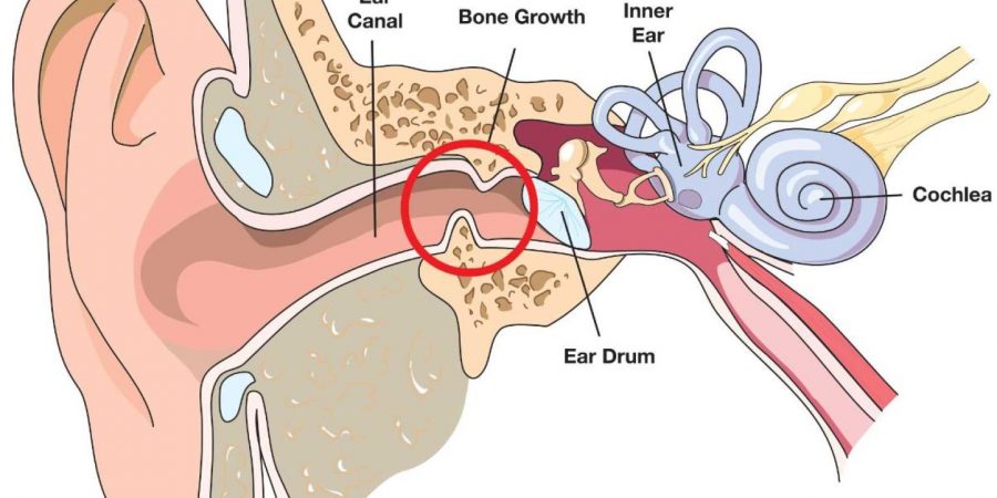 What is Surfer’s Ear? Treatment and  How to Prevent It [TIPS]